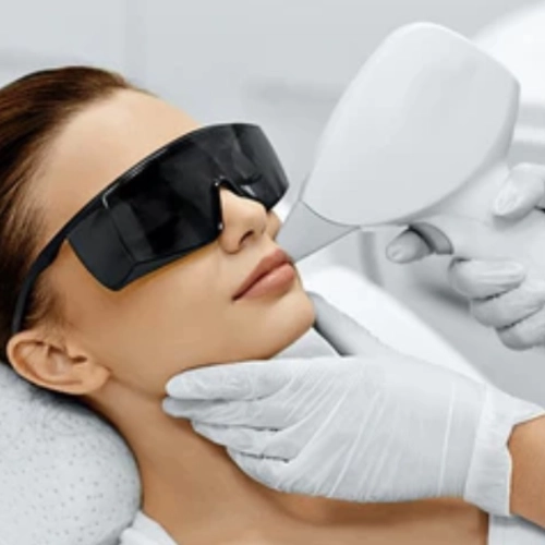Laser Haarentfernung im Gesicht