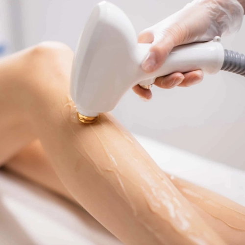 Laser Haarentfernung am Bein